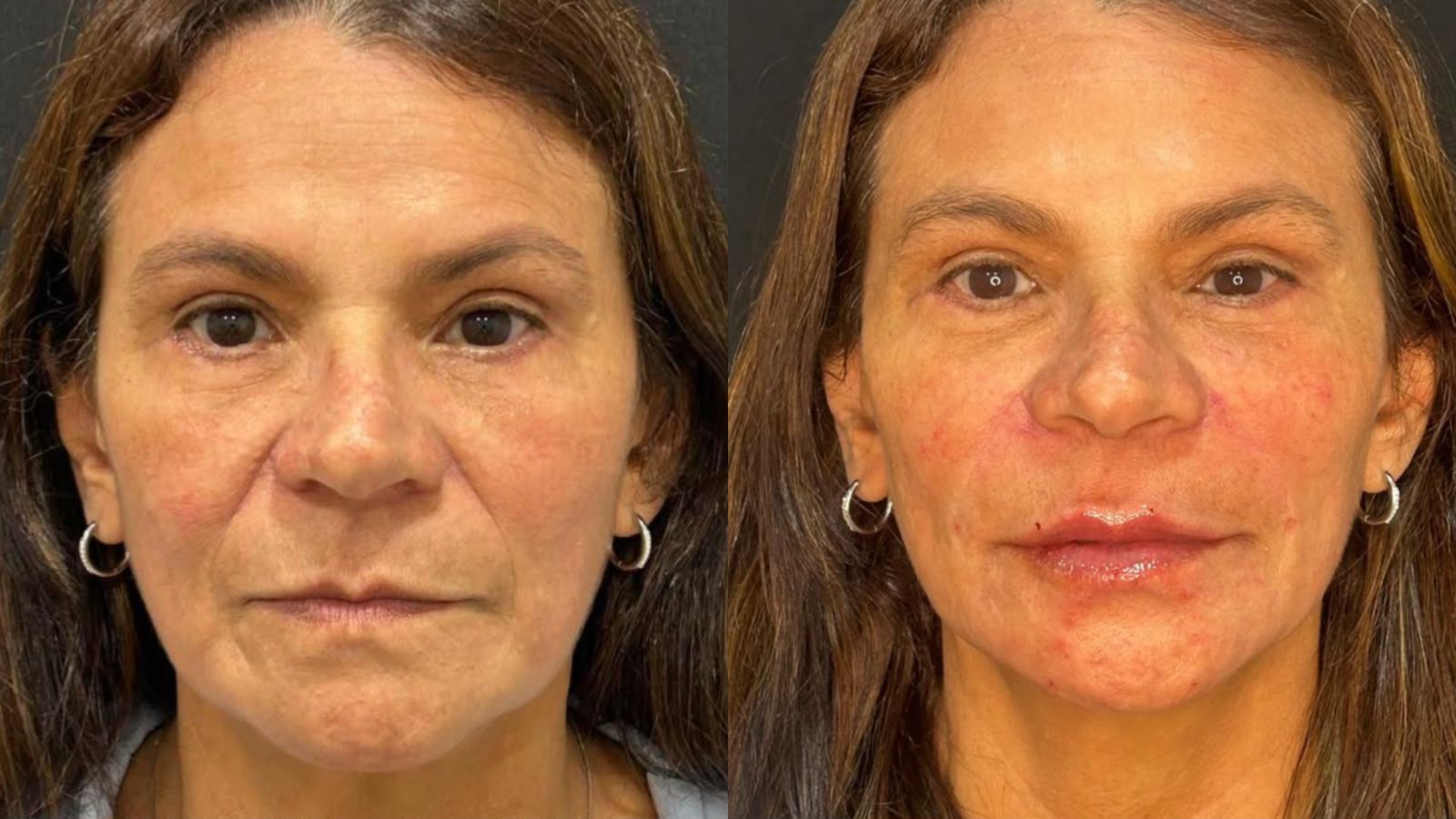 Antes e depois de Full Face