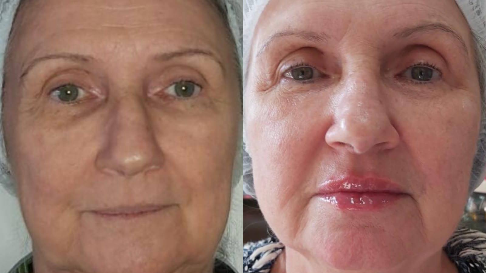Antes e depois de Preenchimento Labial