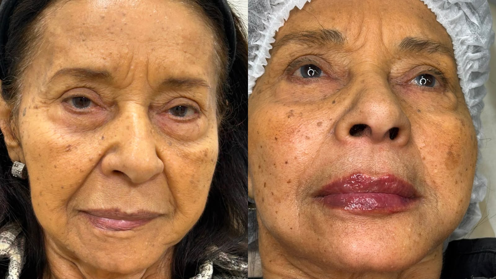 Antes e depois de Botox e Preenchimento Labial