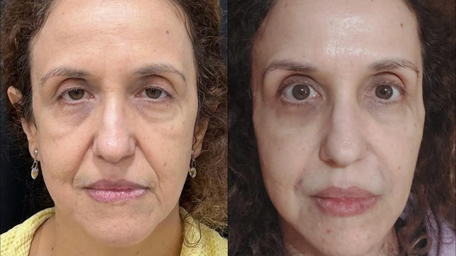 Antes e depois de Full Face