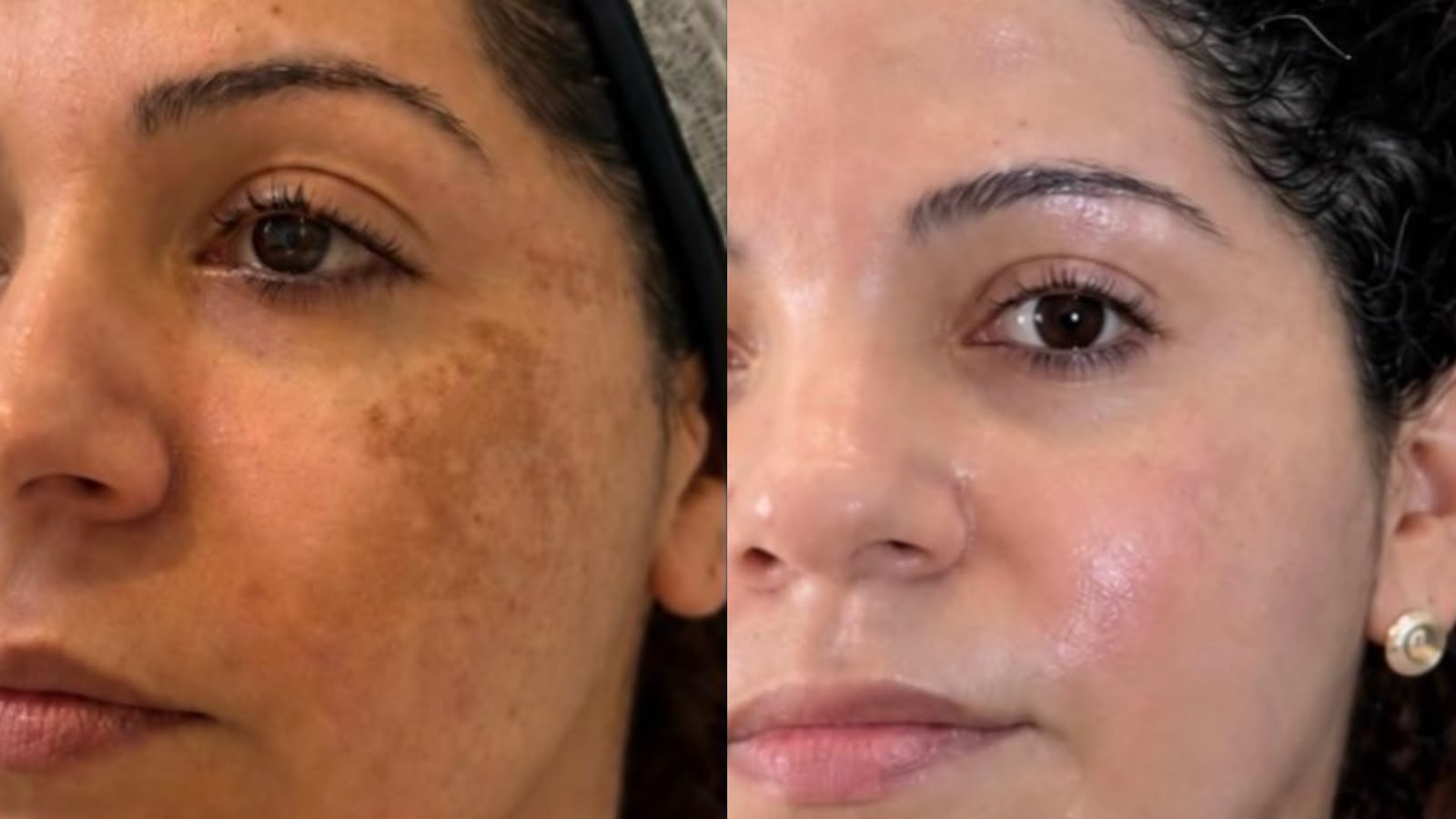 Antes e depois de Tratamento de Melasma