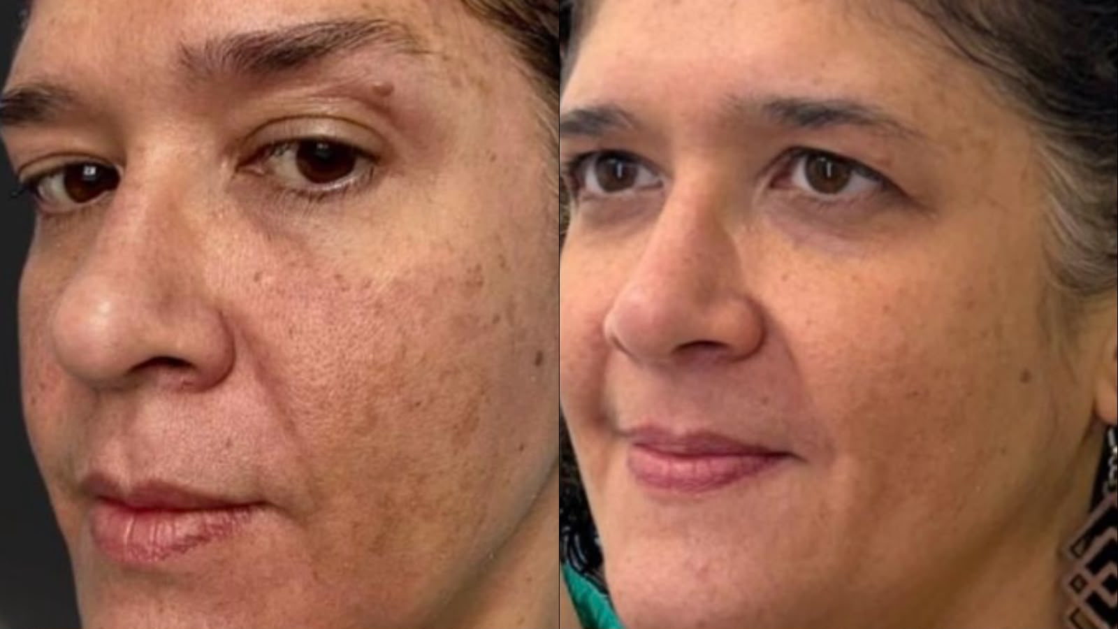 Antes e depois de Peeling em Manchas
