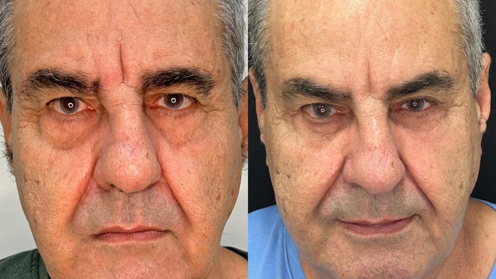Antes e depois de Preenchimento de Olheiras