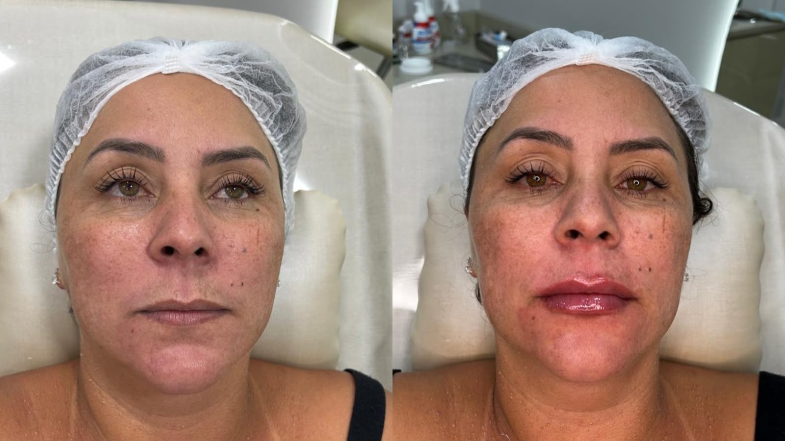 Antes e depois de Preenchimento Labial