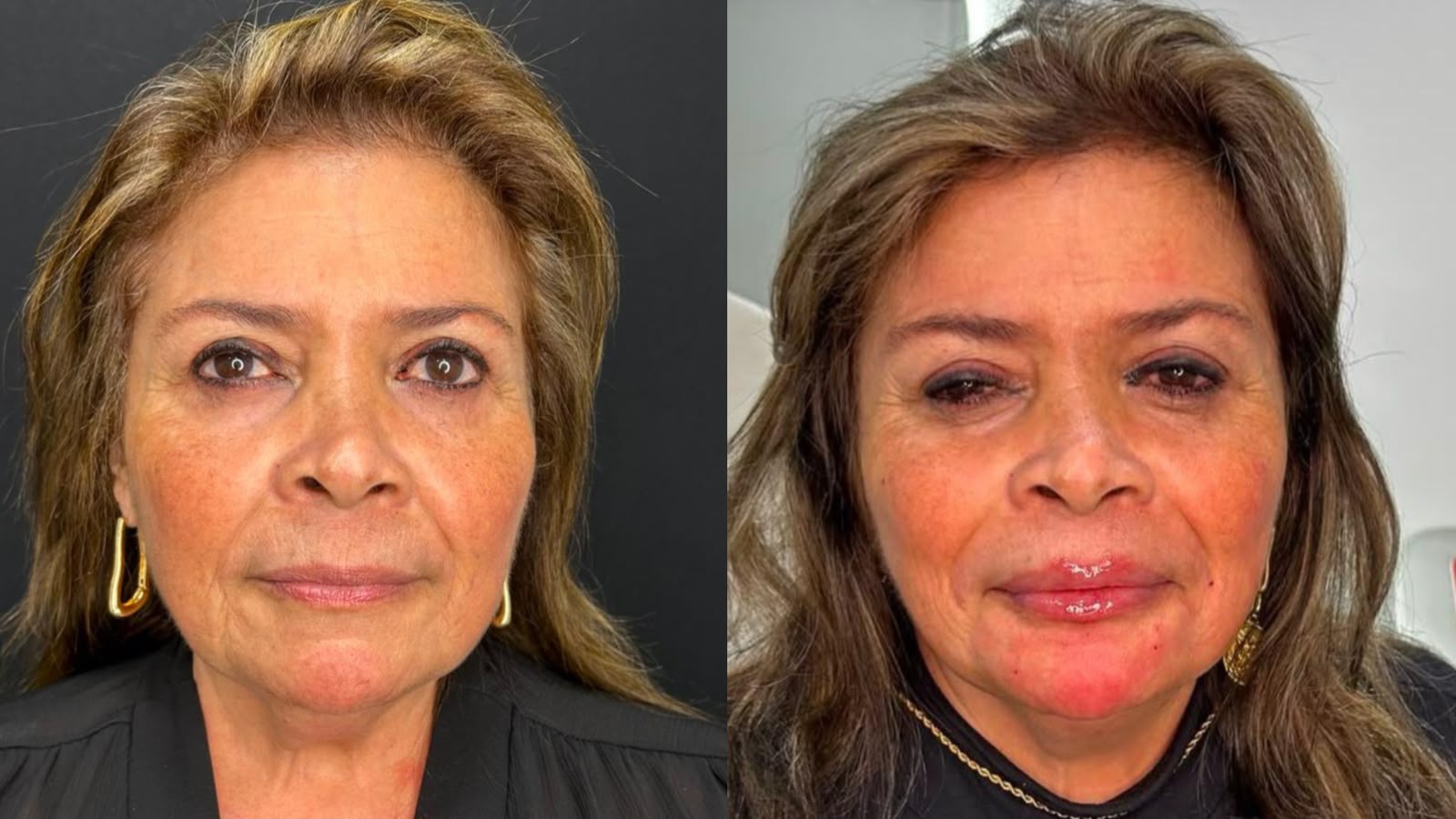 Antes e depois de Preenchimento Labial