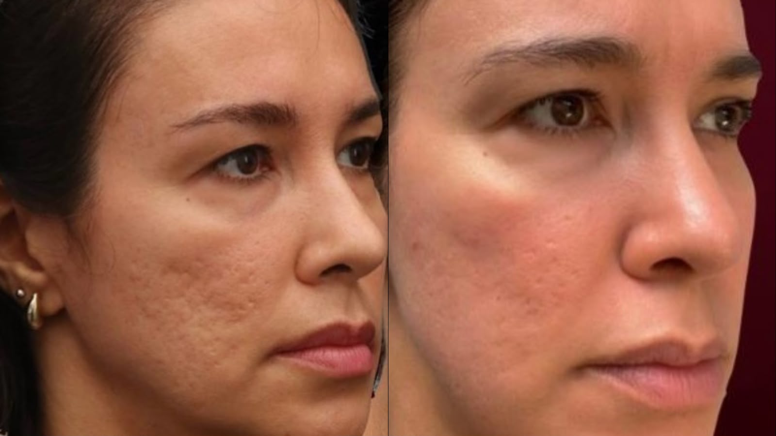 Antes e depois de Peeling em Cicatriz de Acne