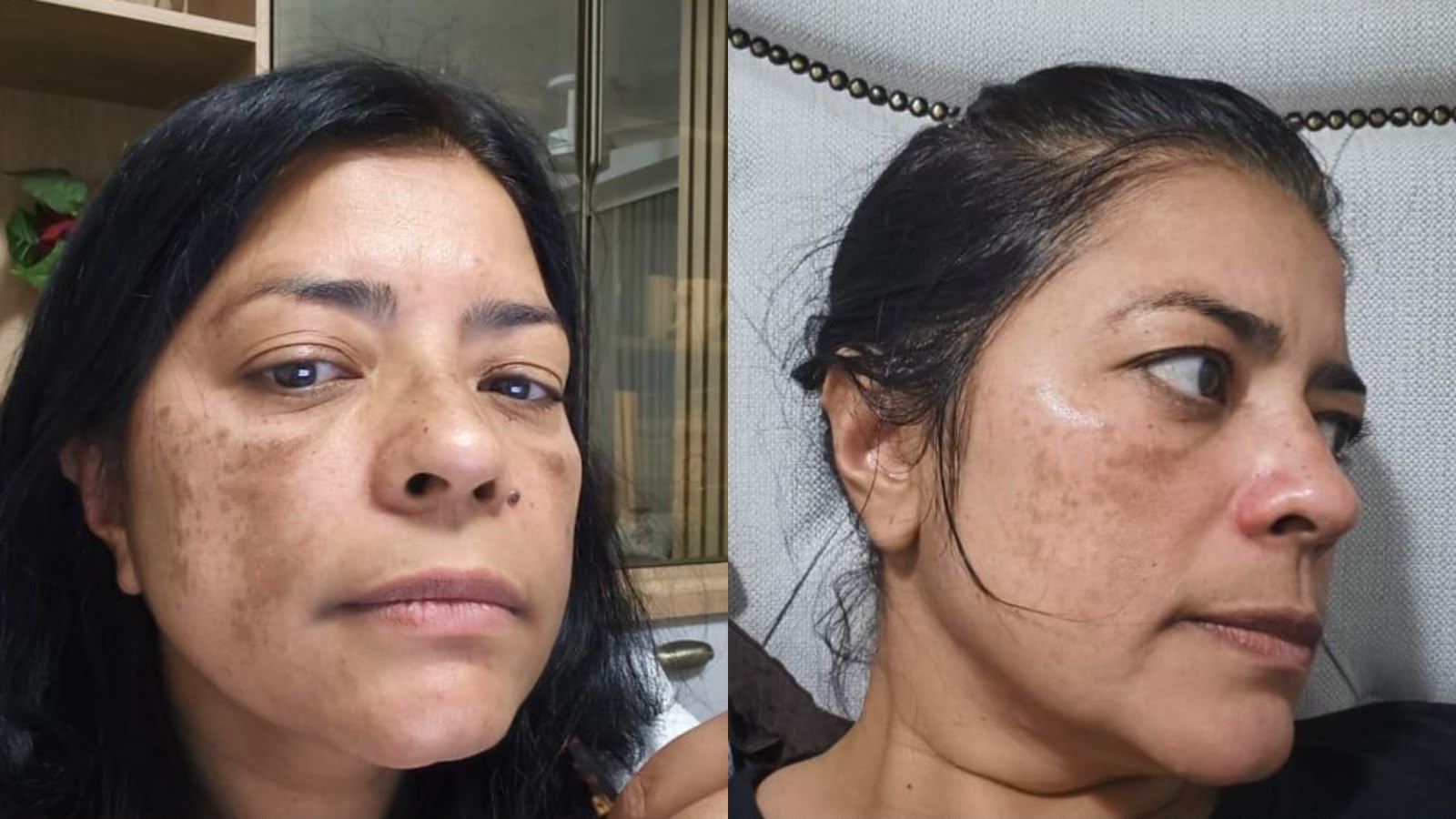 Antes e depois de Tratamento de Melasma