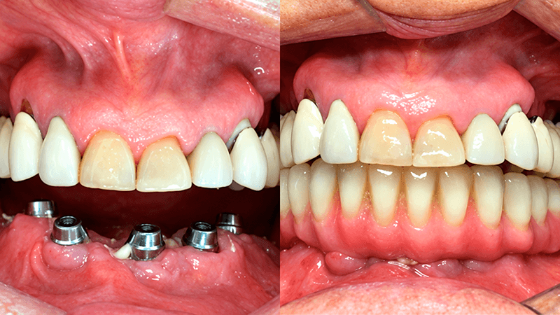 Protocolo sobre Implantes