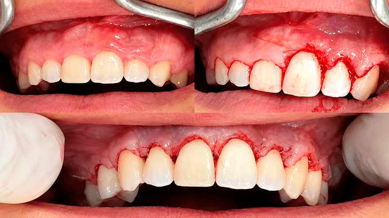 GENGIVOPLASTIA